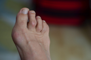 Causes and Treatment of Hammertoe