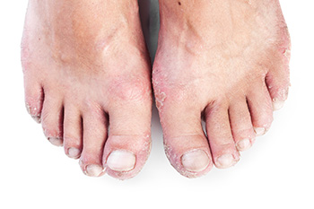 Help for Psoriatic Arthritis of the Feet