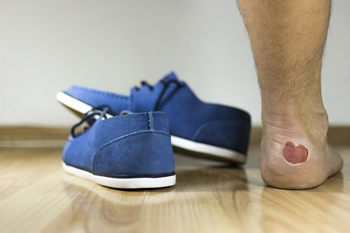 Causes of Foot Blisters in Low Friction Scenarios and Soft Tissue Distortions