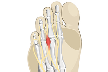 Recognizing Common Symptoms of Morton’s Neuroma