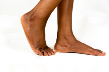 Treatment of Adult Acquired Flat Feet